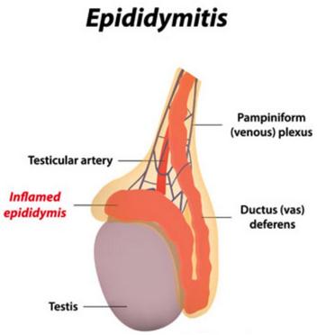 epididymitis treatment