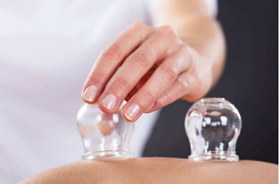 cupping