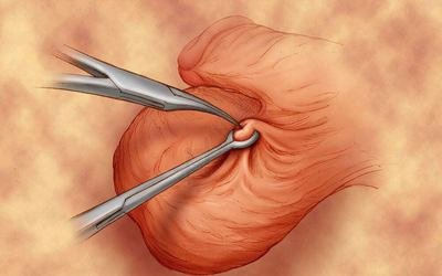 SeminalVesiculitisandBlockedVasDeferens