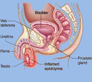 chronic epididymitis 