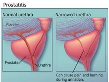 prostatitis treatment