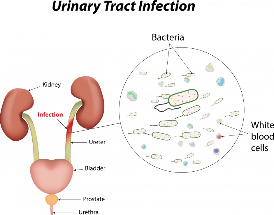 UTI treatment