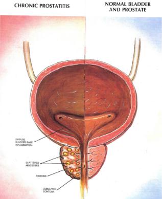 prostatitis cure