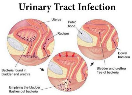 treatment of urinary track infection
