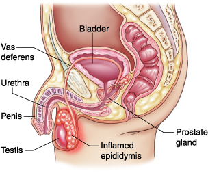 treat epididymitis