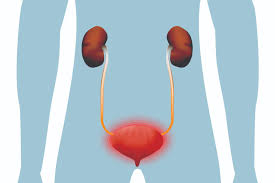 urniary tract infection